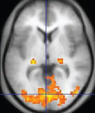 fMRI image showing the brain from a top view with active areas colored in orange