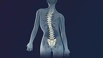3D Medical Animation still shot of Scoliosis