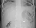 AP X ray showing a 9mm battery in the intestines