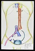 An empty abdomen during a six-organ transplant. Watercolour by Sir Roy Calne, 1994.