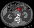An aortic aneurysm as seen on CT with a small area of remaining blood flow