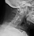 Lateral X-ray of the neck in ankylosing spondylitis