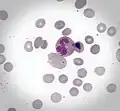 Cabot rings inside atypical erythrocyte. May-Grunwald staining (x400)
