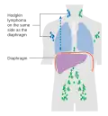 Stage 2 Hodgkin lymphoma