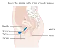 Stage 4A vulvar cancer