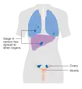 Stage 4 ovarian cancer