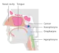 Stage T1 nasopharyngeal cancer