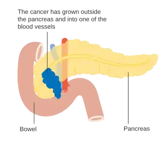 Stage T4 pancreatic cancer