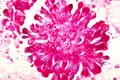Sarcoma