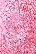 Micrograph showing a thrombus (center of image) within a blood vessel of the placenta. H&E stain.