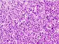 Poorly differentiated HCC