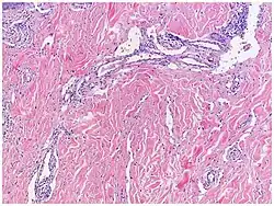 Micrograph of promontory sign in Kaposi's sarcoma in patch stage. Dilated irregular vascular channels surround a pre-existing vessel.[16]