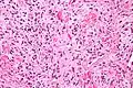Solitary fibrous tumor - high magnification. H&E stain.