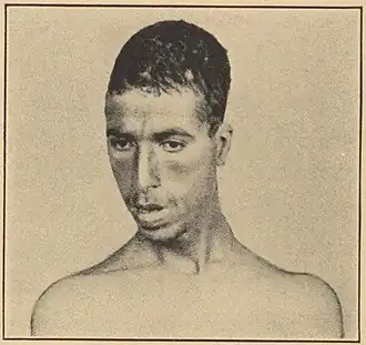 Congenital syphilis