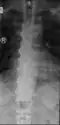 DISH spine