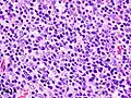Histopathological image of thymoma type B1. Anterior mediastinal mass surgically resected. Hematoxylin & eosin stain.