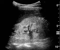 Nephrotic syndrome. Hyperechoic kidney without demarcation of cortex and medulla.[63]