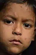 A child with chickenpox