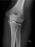 Anteroposterior projection